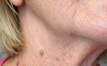 My neighbor Barbara uses this simple three ingredient trick to make stubborn skin tags fall right off