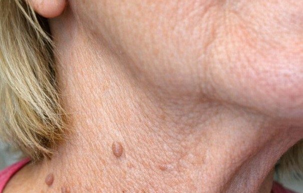 My neighbor Barbara uses this simple three ingredient trick to make stubborn skin tags fall right off