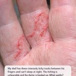 My dad has these intensely itchy tracks between his fingers and can’t sleep at night. The itching is unbearable and the doctor is booked up. What works?