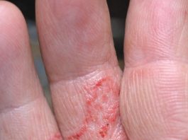 My dad has these intensely itchy tracks between his fingers and can’t sleep at night. The itching is unbearable and the doctor is booked up. What works?