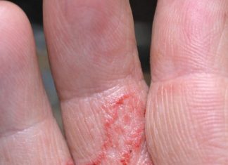 My dad has these intensely itchy tracks between his fingers and can’t sleep at night. The itching is unbearable and the doctor is booked up. What works?