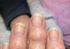 My grandma has these hard bumps forming on her finger joints near the nails. Why is this spreading?