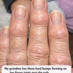 My grandma has these hard bumps forming on her finger joints near the nails. Why is this spreading?