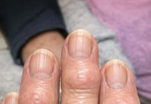 My grandma has these hard bumps forming on her finger joints near the nails. Why is this spreading?