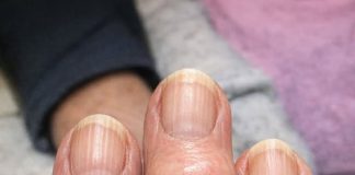 My grandma has these hard bumps forming on her finger joints near the nails. Why is this spreading?