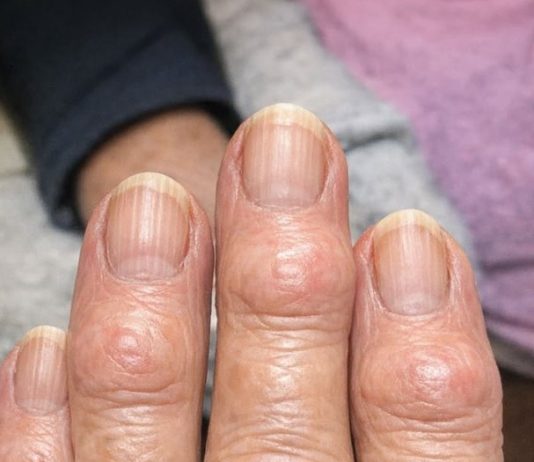 My grandma has these hard bumps forming on her finger joints near the nails. Why is this spreading?
