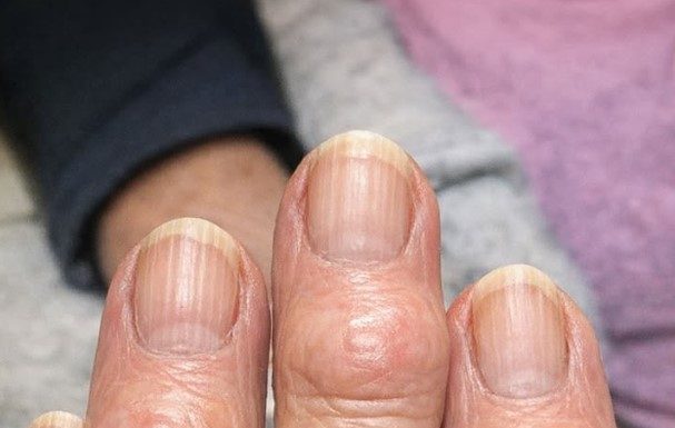 My grandma has these hard bumps forming on her finger joints near the nails. Why is this spreading?