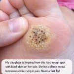 My daughter is limping from this hard rough spot with black dots on her sole. She has a dance recital tomorrow and is crying in pain. Need a fast fix!