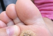 My daughter is limping from this hard rough spot with black dots on her sole. She has a dance recital tomorrow and is crying in pain. Need a fast fix!