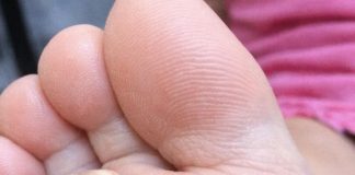 My daughter is limping from this hard rough spot with black dots on her sole. She has a dance recital tomorrow and is crying in pain. Need a fast fix!