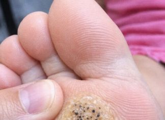 My daughter is limping from this hard rough spot with black dots on her sole. She has a dance recital tomorrow and is crying in pain. Need a fast fix!