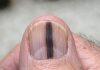 Just noticed this distinct dark stripe running down my dad’s thumb nail. He ignores it, but I’m terrified it’s serious. We can’t see a specialist for weeks. Should I be worried?