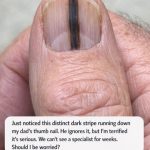 Just noticed this distinct dark stripe running down my dad’s thumb nail. He ignores it, but I’m terrified it’s serious. We can’t see a specialist for weeks. Should I be worried?