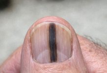 Just noticed this distinct dark stripe running down my dad’s thumb nail. He ignores it, but I’m terrified it’s serious. We can’t see a specialist for weeks. Should I be worried?