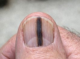 Just noticed this distinct dark stripe running down my dad’s thumb nail. He ignores it, but I’m terrified it’s serious. We can’t see a specialist for weeks. Should I be worried?