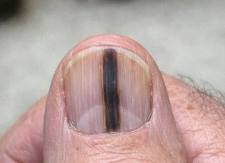 Just noticed this distinct dark stripe running down my dad’s thumb nail. He ignores it, but I’m terrified it’s serious. We can’t see a specialist for weeks. Should I be worried?