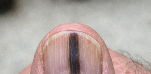 Just noticed this distinct dark stripe running down my dad’s thumb nail. He ignores it, but I’m terrified it’s serious. We can’t see a specialist for weeks. Should I be worried?