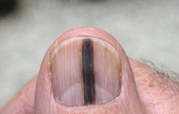Just noticed this distinct dark stripe running down my dad’s thumb nail. He ignores it, but I’m terrified it’s serious. We can’t see a specialist for weeks. Should I be worried?