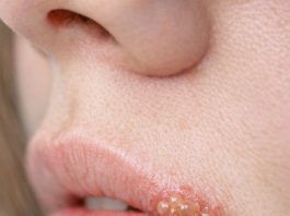 My sister developed this painful bubbling blister on her lip right before her wedding. She is freaking out and needs it gone immediately. Any tips?