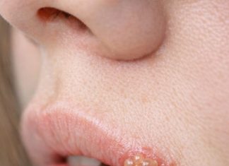 My sister developed this painful bubbling blister on her lip right before her wedding. She is freaking out and needs it gone immediately. Any tips?