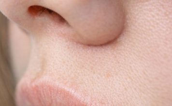 My sister developed this painful bubbling blister on her lip right before her wedding. She is freaking out and needs it gone immediately. Any tips?