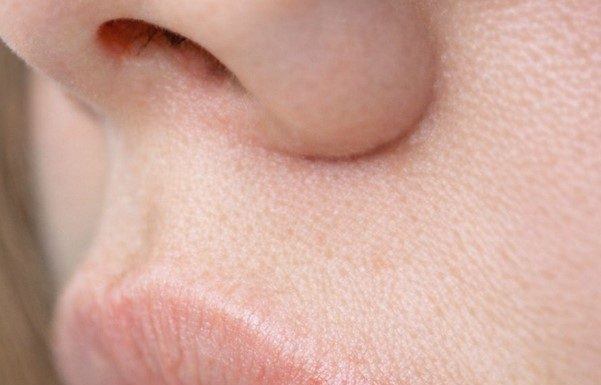 My sister developed this painful bubbling blister on her lip right before her wedding. She is freaking out and needs it gone immediately. Any tips?