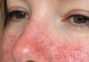 Visible Broken Blood Vessels on the Face: What They Might Be and What to Do