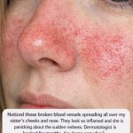 Visible Broken Blood Vessels on the Face: What They Might Be and What to Do