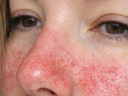 Visible Broken Blood Vessels on the Face: What They Might Be and What to Do