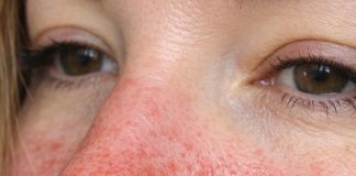 Visible Broken Blood Vessels on the Face: What They Might Be and What to Do