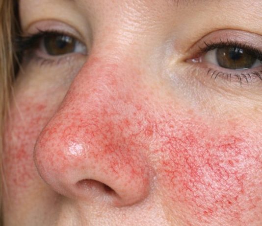 Visible Broken Blood Vessels on the Face: What They Might Be and What to Do