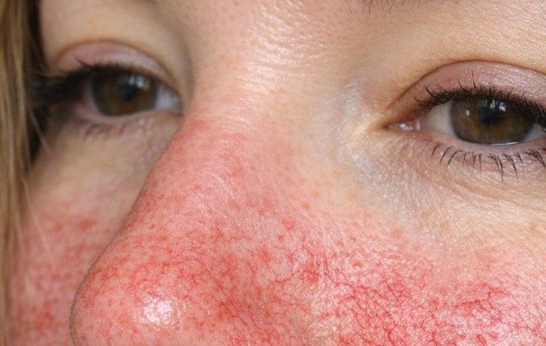 Visible Broken Blood Vessels on the Face: What They Might Be and What to Do
