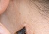 Rub this 1 solution on your neck and get rid of skin tags and raised bumps