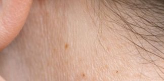Rub this 1 solution on your neck and get rid of skin tags and raised bumps