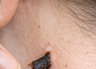 Rub this 1 solution on your neck and get rid of skin tags and raised bumps
