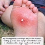 My son stepped on something in the yard and his foot is swelling up so fast. He is crying in pain and I don’t know if I should extract the stinger myself or rush to urgent care. What is this?