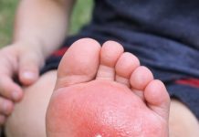 My son stepped on something in the yard and his foot is swelling up so fast. He is crying in pain and I don’t know if I should extract the stinger myself or rush to urgent care. What is this?