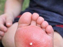 My son stepped on something in the yard and his foot is swelling up so fast. He is crying in pain and I don’t know if I should extract the stinger myself or rush to urgent care. What is this?