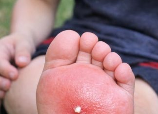 My son stepped on something in the yard and his foot is swelling up so fast. He is crying in pain and I don’t know if I should extract the stinger myself or rush to urgent care. What is this?