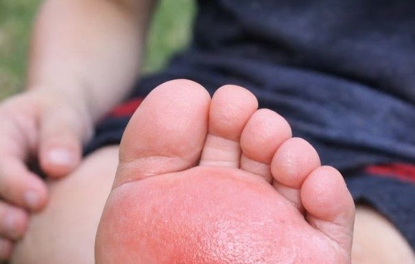 My son stepped on something in the yard and his foot is swelling up so fast. He is crying in pain and I don’t know if I should extract the stinger myself or rush to urgent care. What is this?