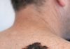 My husband has had this mole forever but it suddenly changed shape and color. We can’t get a doctor’s appointment for weeks and I’m worried sick. Does this look concerning?