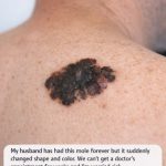 My husband has had this mole forever but it suddenly changed shape and color. We can’t get a doctor’s appointment for weeks and I’m worried sick. Does this look concerning?