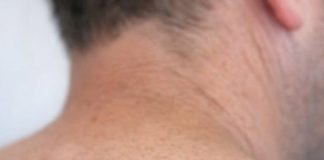 My husband has had this mole forever but it suddenly changed shape and color. We can’t get a doctor’s appointment for weeks and I’m worried sick. Does this look concerning?