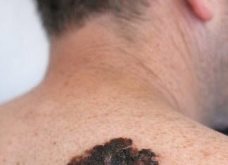 My husband has had this mole forever but it suddenly changed shape and color. We can’t get a doctor’s appointment for weeks and I’m worried sick. Does this look concerning?