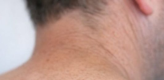My husband has had this mole forever but it suddenly changed shape and color. We can’t get a doctor’s appointment for weeks and I’m worried sick. Does this look concerning?