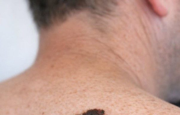 My husband has had this mole forever but it suddenly changed shape and color. We can’t get a doctor’s appointment for weeks and I’m worried sick. Does this look concerning?