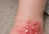 My daughter stepped in a mound while playing in the grass. Her foot erupted in these white blisters and she won’t stop crying. I’m worried about an allergic reaction. Help?