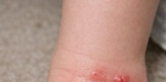 My daughter stepped in a mound while playing in the grass. Her foot erupted in these white blisters and she won’t stop crying. I’m worried about an allergic reaction. Help?