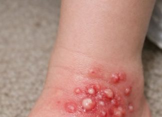 My daughter stepped in a mound while playing in the grass. Her foot erupted in these white blisters and she won’t stop crying. I’m worried about an allergic reaction. Help?