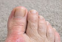 My mom is crying from the pain of this bump on her foot. She can’t even wear shoes and the specialist is booked for weeks. Does anyone have a quick fix?